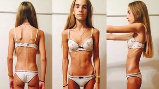 La valentía de Delfina: a los 17 años se animó a compartir su dura lucha contra la anorexia
