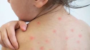 Alerta sanitaria: la región de las Américas perdió su estatus de libre de sarampión