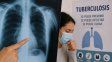 Tuberculosis en Santa Fe: los casos aumentaron un 33% en lo que va de 2026 y la provincia está entre las más afectadas del país