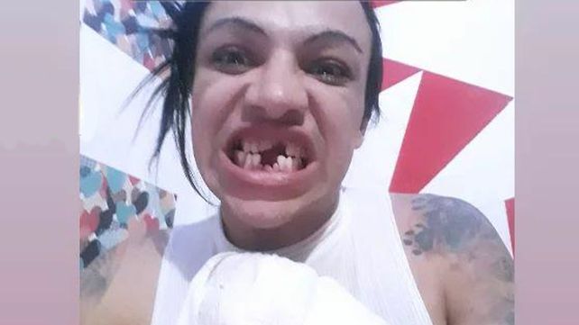 Noelia, la chica trans agredida el miércoles por la noche, mostró en las redes las consecuencias de la violencia.