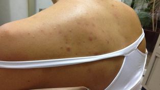 Varicela, enfermedad de los primeros fríos
