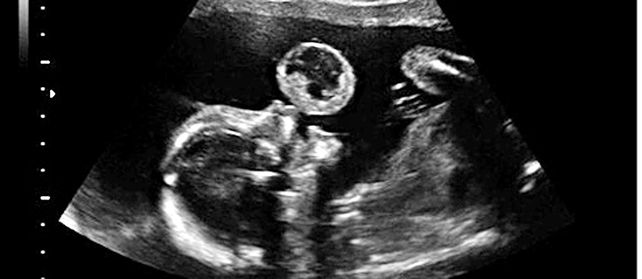 La ecografía muestra el tumor del tamaño de una pelota de tenis que nace de la boca de la niña. La malformación es fatal.