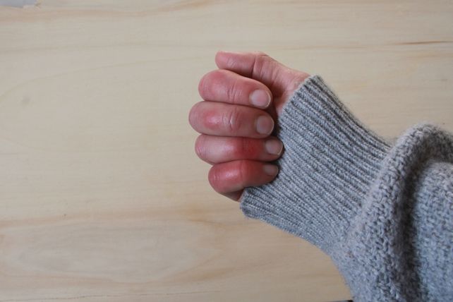 Un problema que afecta distintas zonas del cuerpo. ¿Cómo se trata?&nbsp;