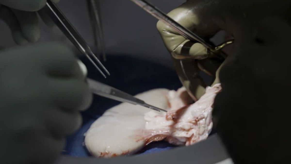 They transplanted a kidney from a pig to a man and it worked