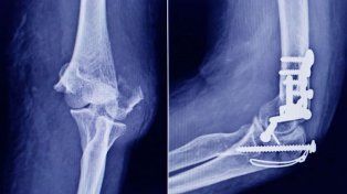 Anmat advierte que un tornillo utilizado en cirugías traumatológicas es falso.