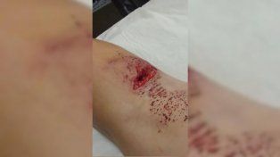 Un perro atacó a un nene de siete años en Santa Rosa de Lima: el dueño no hizo nada