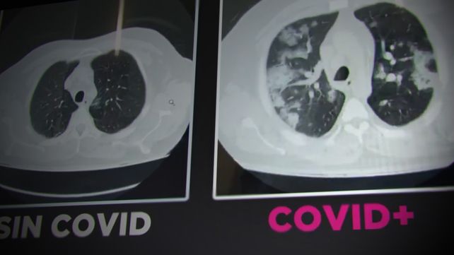 Como se ven los pulmones con y sin Covid. (Foto: captura de video)