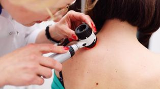 El 40% de los casos de melanoma a nivel global se diagnostican antes de los 55 años.