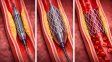 Anmat prohibió la comercialización dos unidades de sistema de stent determinados porque habían sido robados