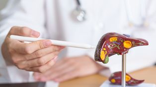 Cáncer colorrectal: nuevas estrategias para tratar las metástasis hepáticas