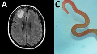 La resonancia magnética del cerebro mostraba extrañas manchas. A la derecha, el enorme gusano extraído del cerebro de la paciente.