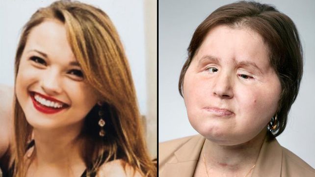 La historia de la chica que recibió un trasplante total de cara