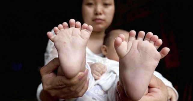 Asombro por el bebé chino que tiene 31 dedos