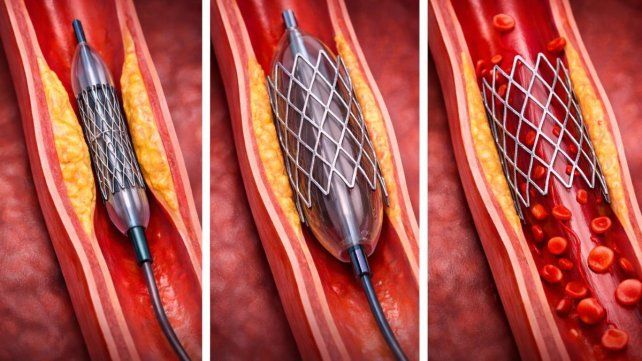 Los sistemas de stent fueron robados