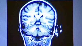 La p&eacute;rdida de la capacidad cognitiva comienza a los 45 a&ntilde;os