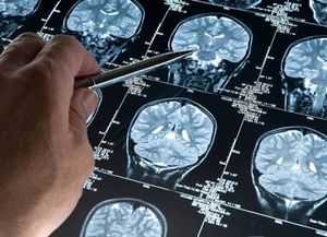 Análisis de sangre pueden detectar el Alzheimer tres años antes de que se desate