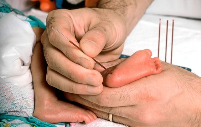 El pinchazo en el talón se realiza en forma obligatoria a todo recién nacido. Es para detectar varias enfermedades genéticas y hereditarias.
