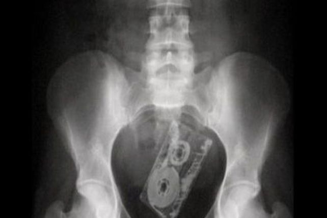 Atorados, las 100 radiografías más insólitas