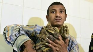 El hombre árbol, luego de 24 cirugías, sufre una recaída