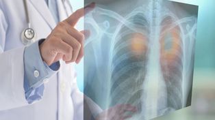 Los casos de cáncer en menores de 50 crecen en el mundo y también en Argentina