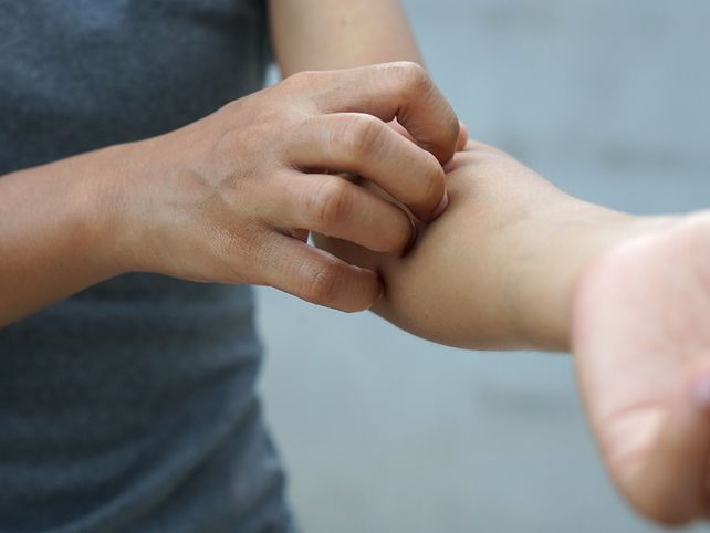 Dermatitis Atópica