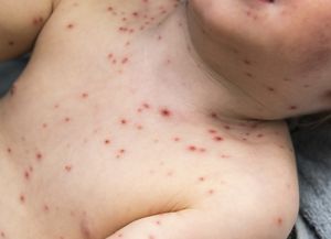 Alerta epidemiológico por dos casos autóctonos de sarampión
