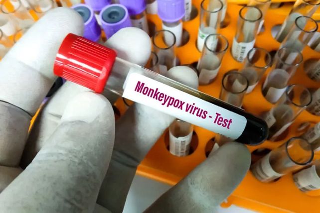 Argentina registra 13 casos de viruela símica o viruela del mono confirmados hasta el 14 de julio