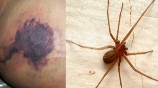 Alertan sobre picaduras de las arañas rinconeras en la provincia