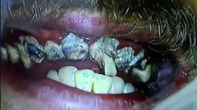 Mostró sus dientes luego de 20 años sin lavárselos