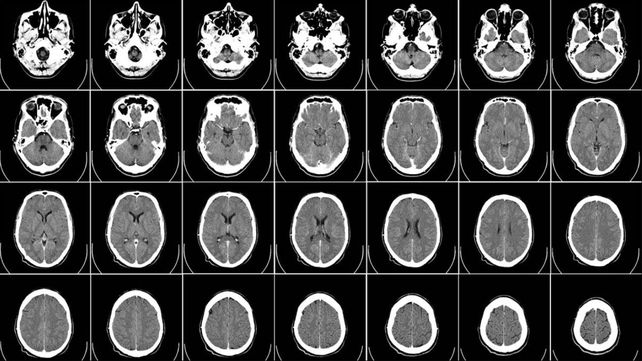 Alzheimer: Identificaron perfiles característicos de la progresión de esta enfermedad