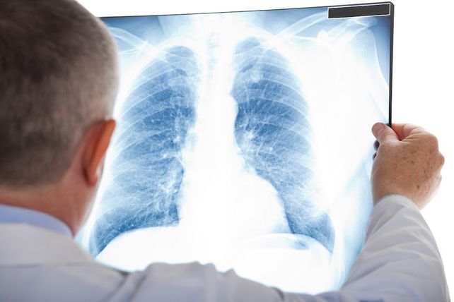 Nódulo pulmonar: qué significa encontrarlo en una tomografía y cuándo puede ser cáncer
