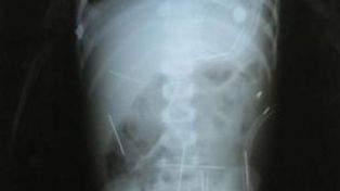 Intentar&aacute;n operar en Brasil a un chico para extraerle 50 agujas de su cuerpo