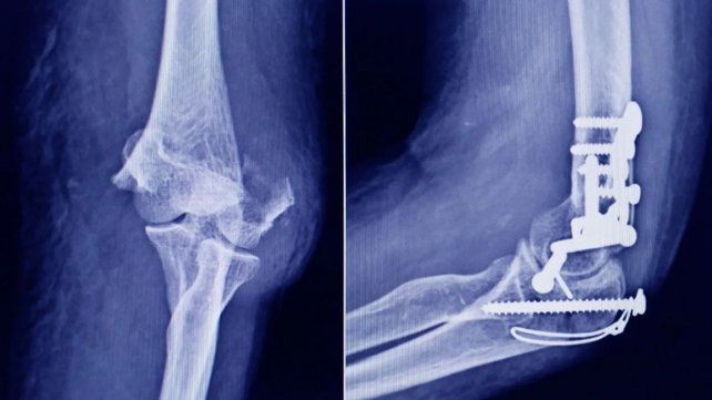Anmat advierte que un tornillo utilizado en cirugías traumatológicas es falso.