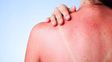Ola de calor e insolación: remedios buenos y baratos para remediar el exceso de sol
