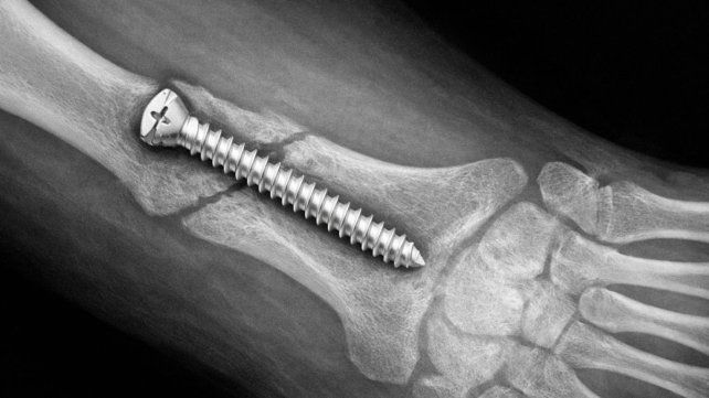 Anmat alerta sobre una pieza de ortopedia falsificada