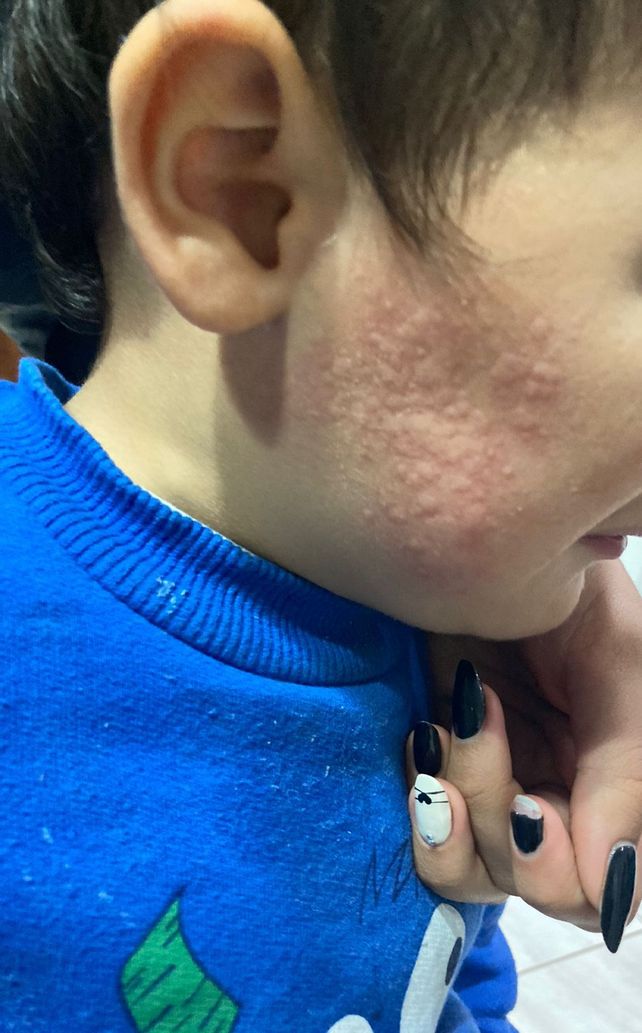 Un niño con erupciones en la piel luego de que el campo cercano a su vivienda fuera asperjado con agroquímicos en Gálvez.