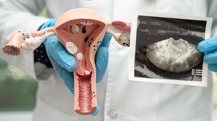 ¿Qué es el síndrome de ovario poliquístico?