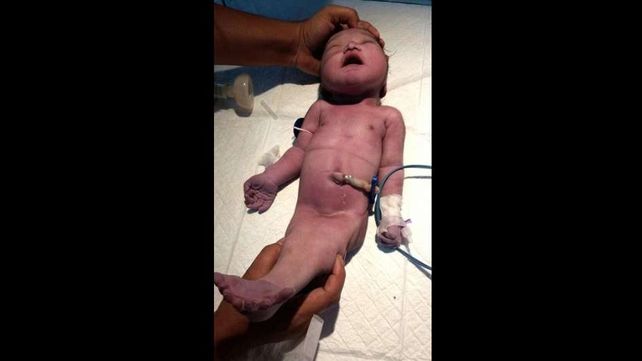 Bebé sirena sorprendió a la comunidad médica
