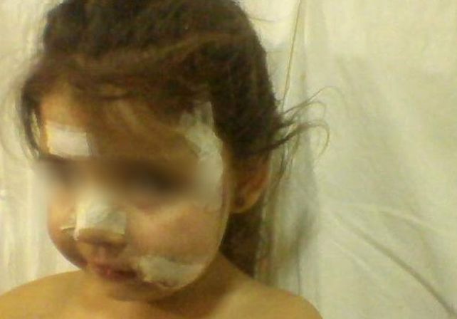 Un perro callejero desfiguró a una nena de tres años en San Lorenzo