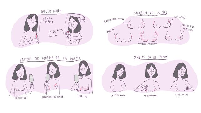 Primera guía de mastólogos para mujeres con cáncer de mama