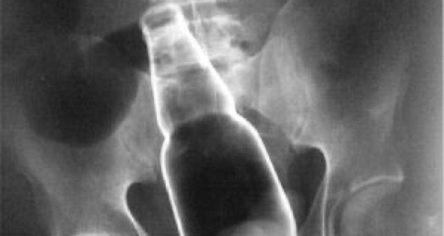 Un hombre violó a su yerno con una botella porque había abusado de su hija