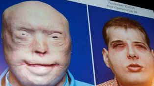 Realizan el más complejo y completo trasplante de cara