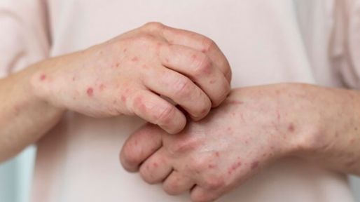 Sarampión: seis entrerrianos bajo control epidemiológico en Concordia