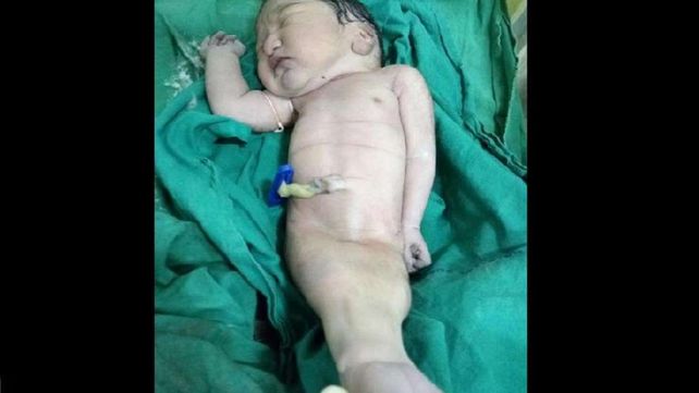 Bebé sirena sorprendió a la comunidad médica