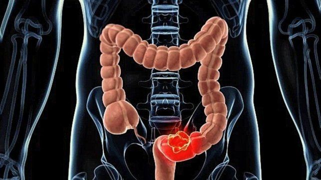 Un nuevo tratamiento contra el cáncer de colon