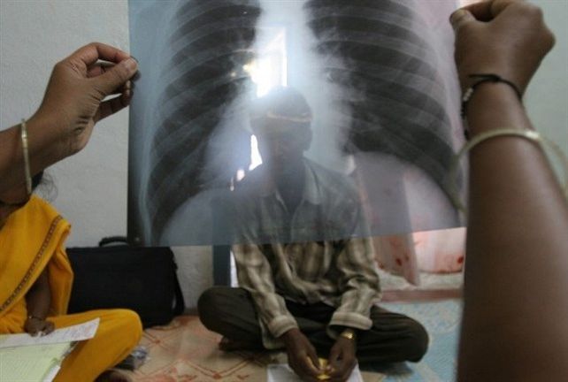 Aumentaron un 38% los casos de tuberculosis en el país
