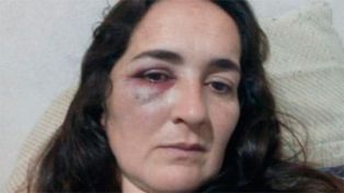 La mujer, víctima de violencia de género, decidió mostrar las marcas de los golpes en las redes&nbsp;