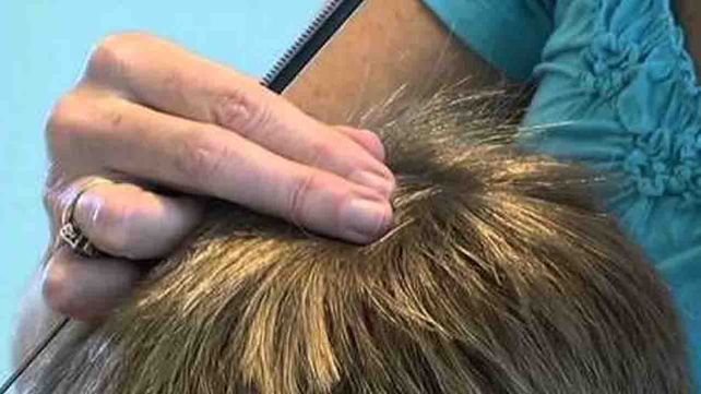 La mejor forma de eliminar los piojos y de manera natural