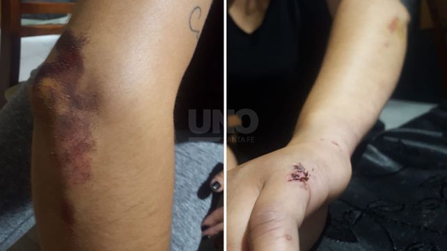 Las heridas sufridas por Magalí