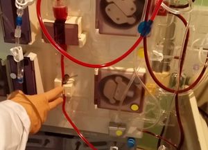 Tenía tanta grasa en la sangre que lo salvaron con una sangría